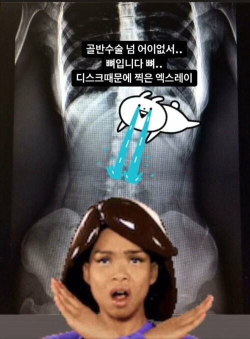 Bị đồn là cắt xương sườn để có 3 vòng bốc lửa, nữ họa sĩ Hàn Quốc đăng ngay ảnh chụp X-quang, tiết lộ sự thật gây sốc - Ảnh 15.